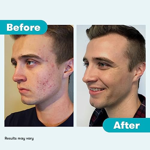 Proactiv 3 Step Acne Treatment - Benzoyl Peroxide Face Wash, Repairing Acne Spot ProactivUS supplements