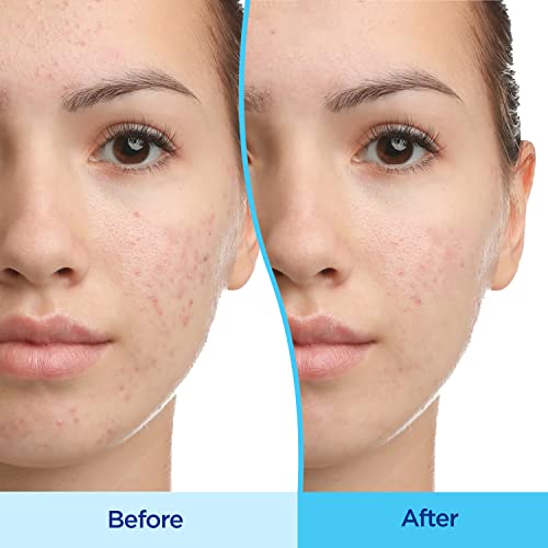 Differin Acne Treatment Gel, 30 Day Supply, Retinoid Treatment for Face DifferinAu supplements