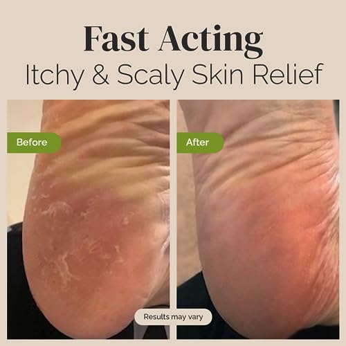 Tea Tree Oil Balm , Extra Strength, Pair Well with Jock Itch Cream, Spray, Athletes Foot PuriyaUS supplements