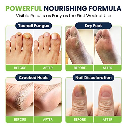 Toenail Fungus Treatment Extra Strength - Advance nail fungus treatment for fingernails FOOT CUREUS supplements