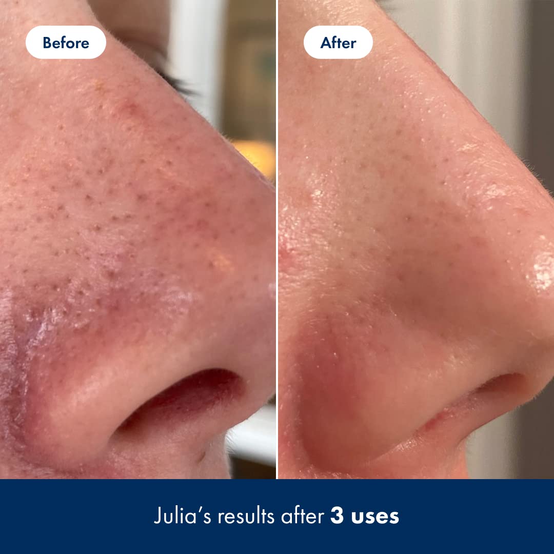 Hero Cosmetics Pore Release Blackhead Clearing Solution - Exfoliating Toner Featuring BHA HERO COSMETICSAu supplements