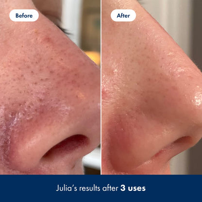 Hero Cosmetics Pore Release Blackhead Clearing Solution - Exfoliating Toner Featuring BHA HERO COSMETICSUS supplements