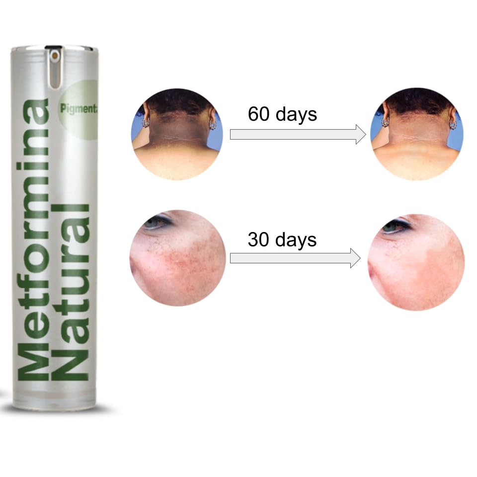 Ni una dieta más METFORMINA NATURAL - Cream for Dark Spots on Face and Body Ni una dieta másUS supplements