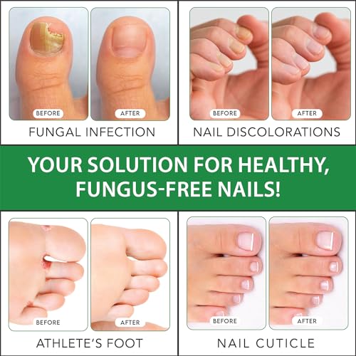 Viking Revolution Toenail Fungus Treatment Extra Strength with 1% Tolnaftate OTC Viking RevolutionUS supplements