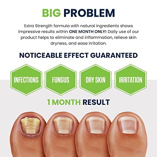 Toenail Fungus Treatment Extra Strength - Advance nail fungus treatment for fingernails FOOT CUREUS supplements