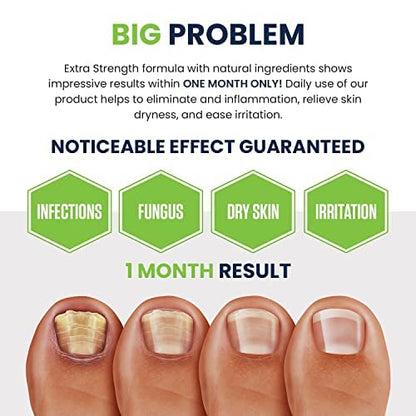 Toenail Fungus Treatment Extra Strength - Advance nail fungus treatment for fingernails FOOT CUREUS supplements