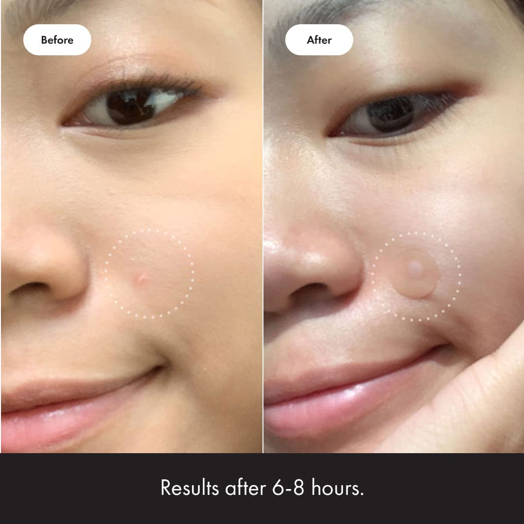 Mighty Patch Original from Hero Cosmetics - Hydrocolloid Acne Pimple Mighty PatchUS supplements