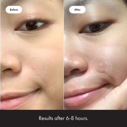 Mighty Patch Original from Hero Cosmetics - Hydrocolloid Acne Pimple Mighty PatchUS supplements