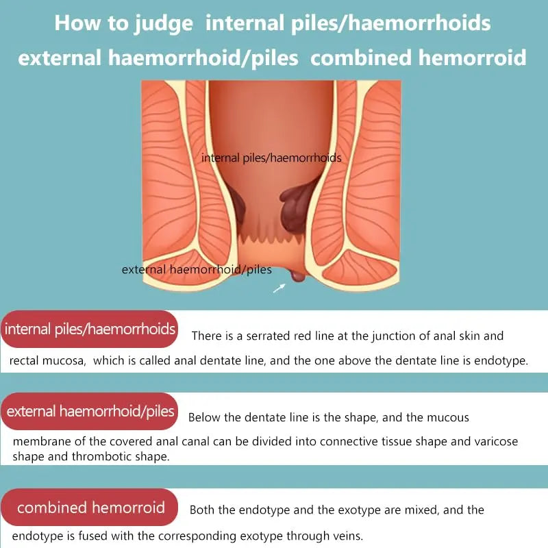 Hemorrhoid Cream for Men and Women, with Lidocaine and Phenylephrine HCl, Provides Fast Relief from hemorrhoid discomfort. Naturally formulated for Hemorrhoids and fissures (0.7 oz) AnisxAu supplements