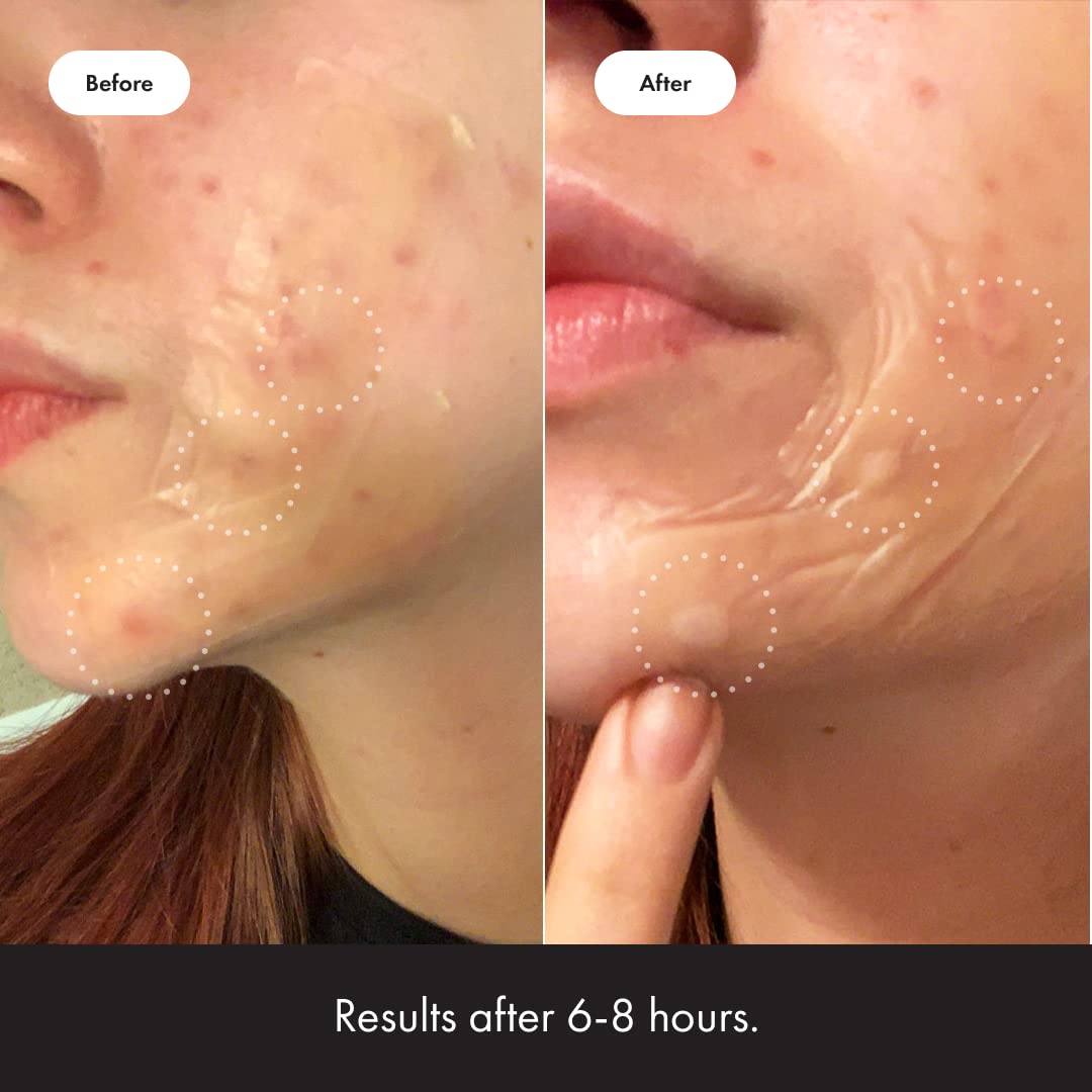 Mighty Patch™ Surface patch from Hero Cosmetics - Hydrocolloid Spot Patch for Body Mighty PatchUS supplements
