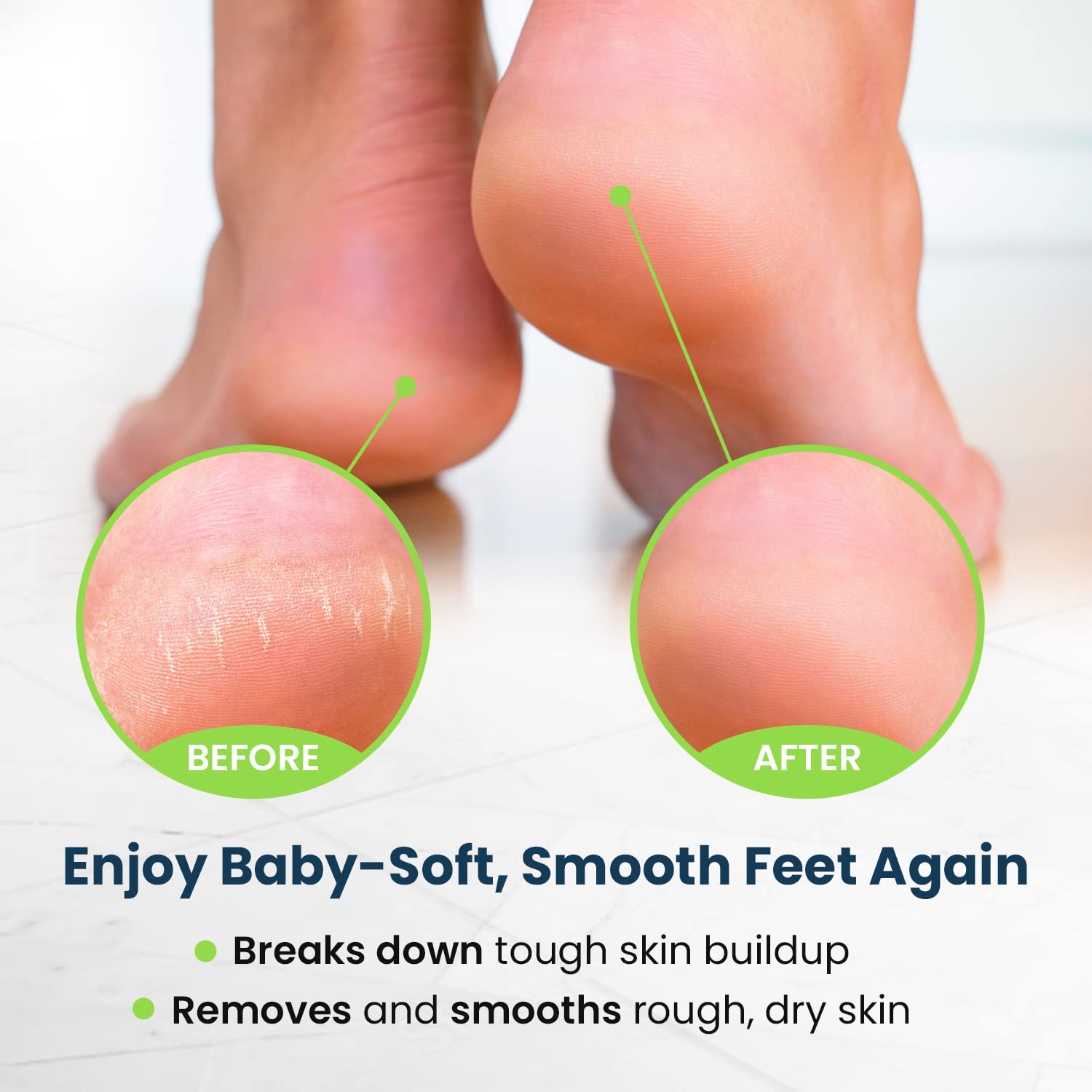 Toenail Fungus Treatment Extra Strength - Advance nail fungus treatment for fingernails FOOT CUREUS supplements