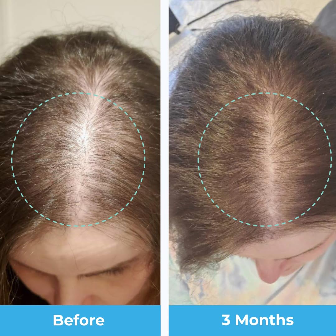 Baby Blues Postpartum Hair Loss Vitamins - Passion Fruit Gummies with Biotin, Collagen, & Folate Baby BluesUS supplements