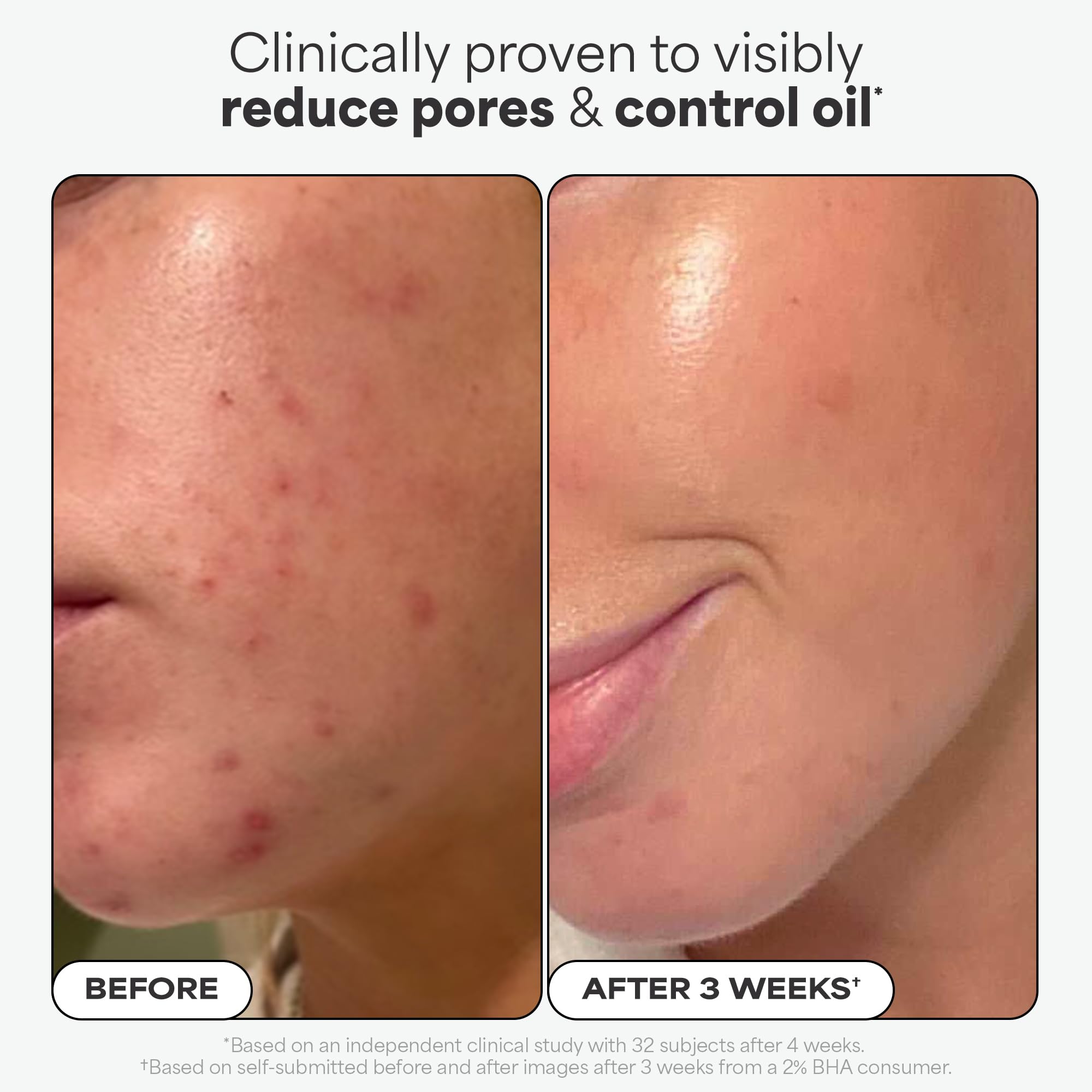 Paulas Choice--SKIN PERFECTING 2% BHA Liquid Salicylic Acid Exfoliant--Facial Exfoliant for Blackheads, Enlarged Pores, Wrinkles & Fine Lines, 4 oz Bottle Paula's ChoiceAu supplements
