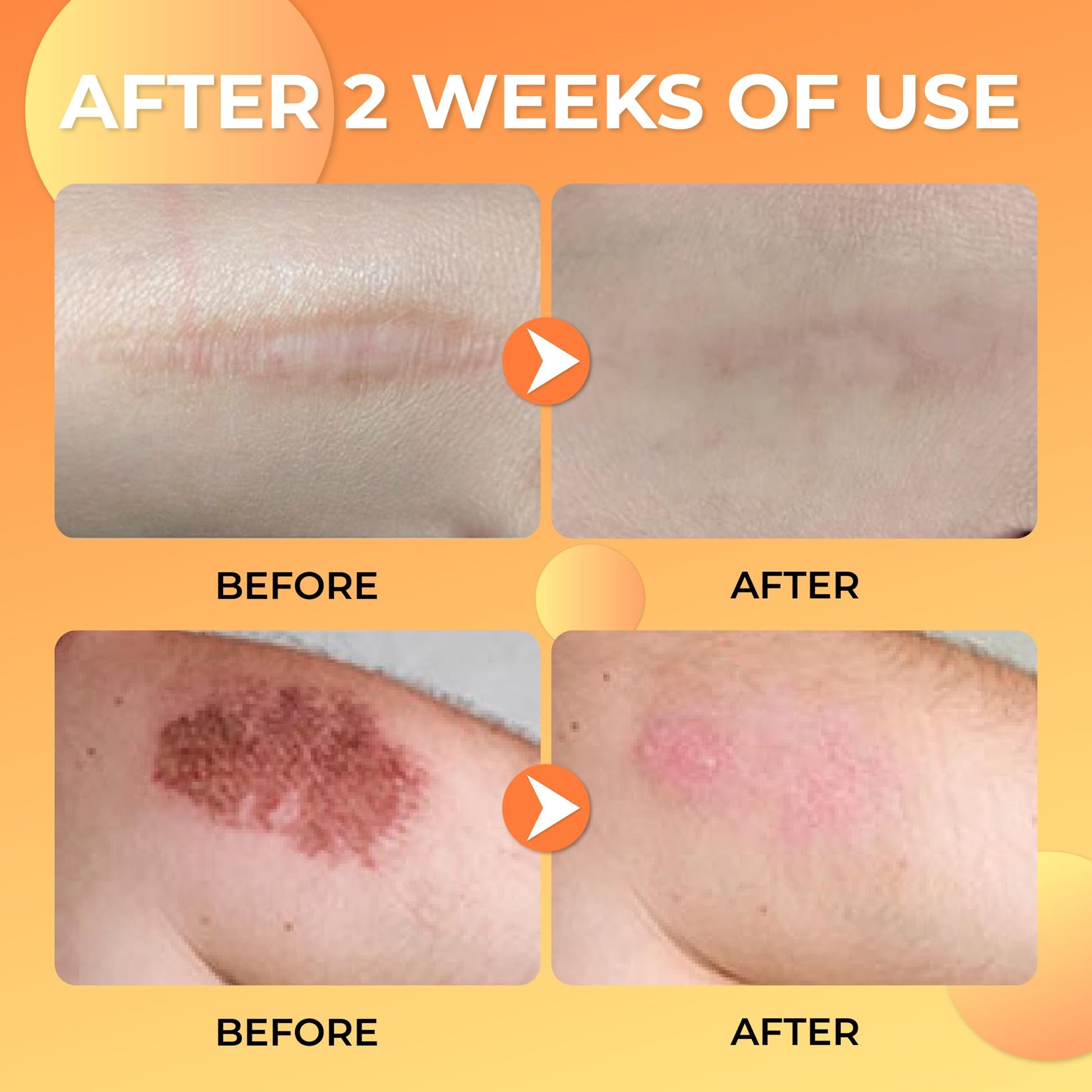ABERA Scar Removal Cream for Women and Men - Rapid Repair of New Old Scars, Spots, Burns All Natural Treatment with Vitamin E, Alanine, Collagen (1 Box + 3 Eye Patch) ABERAAu supplements