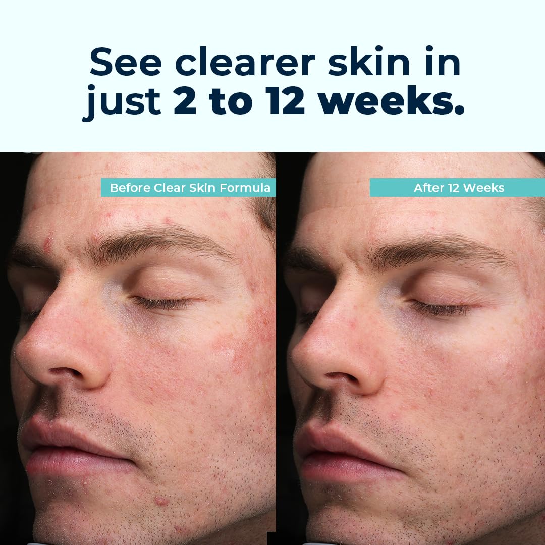 VitaMedica Clear Skin Vitamin Formula | Noncystic Acne Supplement for Skin Clearing | Breakout Treatment for Women and Men | Vitamins A, C, E, Selenium, Chromium, and Zinc for Skin Health | 2 Pack VitaMedicaAu supplements
