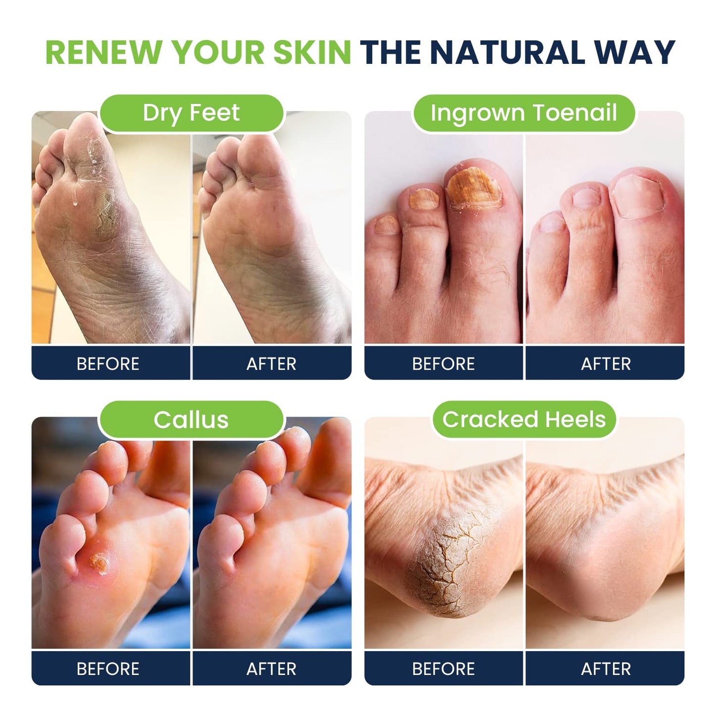 Foot Soak with Epsom Salts- Variety Pack of 4- Tea Tree Oil, Muscle Relief, Calming FOOT CUREUS supplements