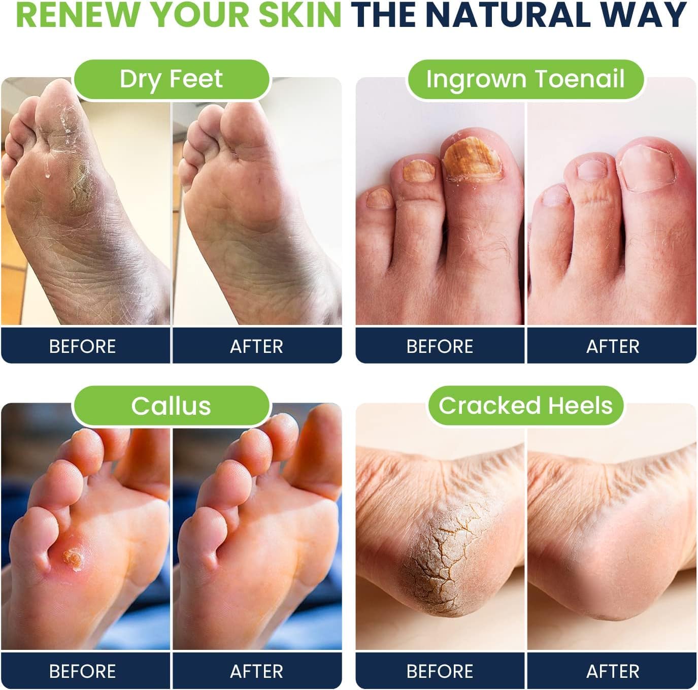 Tea Tree Oil & Citrus Detox Foot Soak with Epsom Salts - All Natural Salts for Post Workout FOOT CUREUS supplements