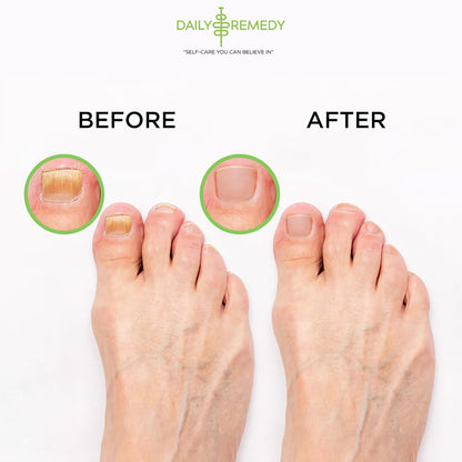 Tea Tree Oil Foot Soak with Epsom Salt - Made in USA - for Toenail Athletes Foot DAILY REMEDYUS supplements