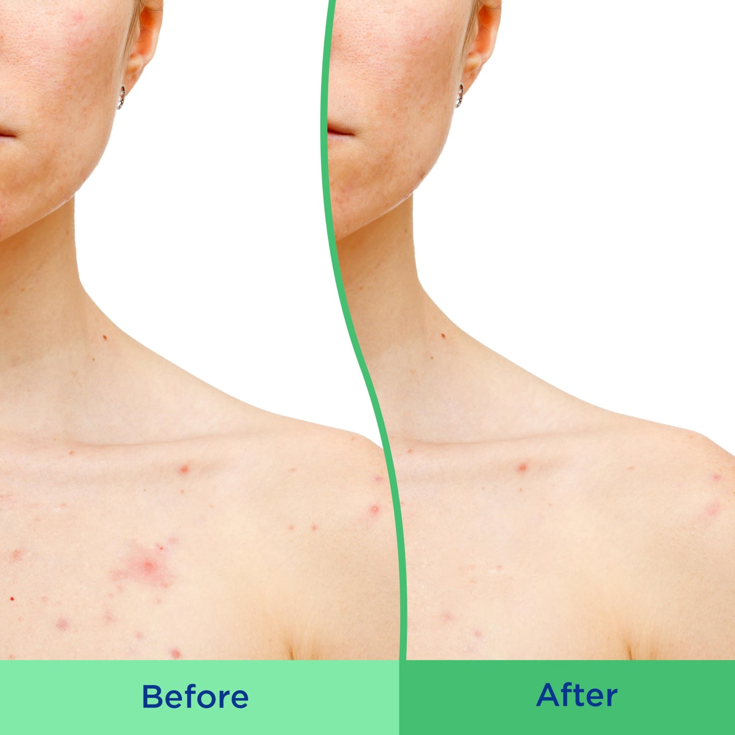 Differin Body Scrub with Salicylic Acid Acne Clearing Improves Tone and Texture Prone Skin DifferinUS supplements