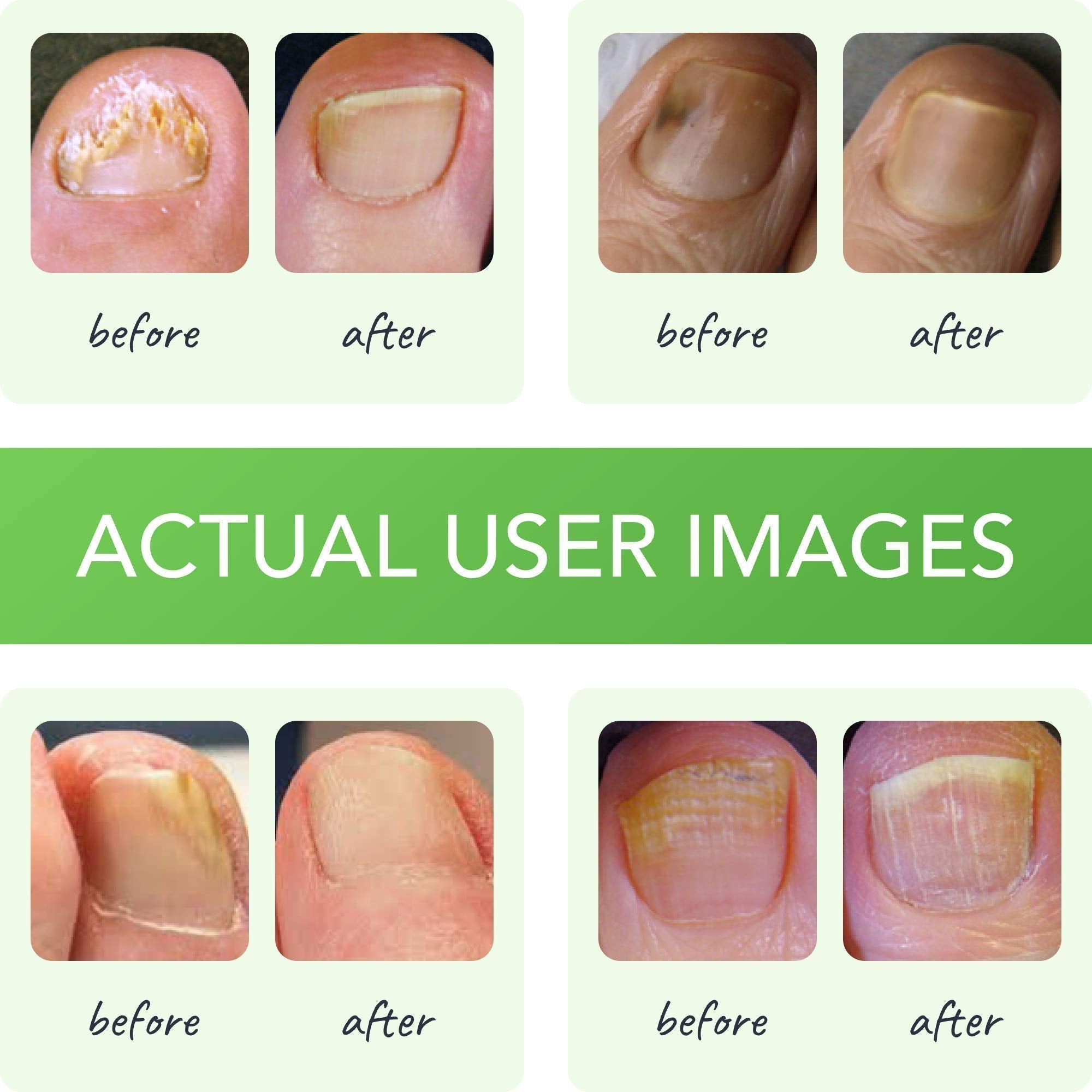 FUNGINIX Healthy Nail Formula - Finger And Toe Fungus Treatment, Made In USA, Foot FUNGINIXUS supplements