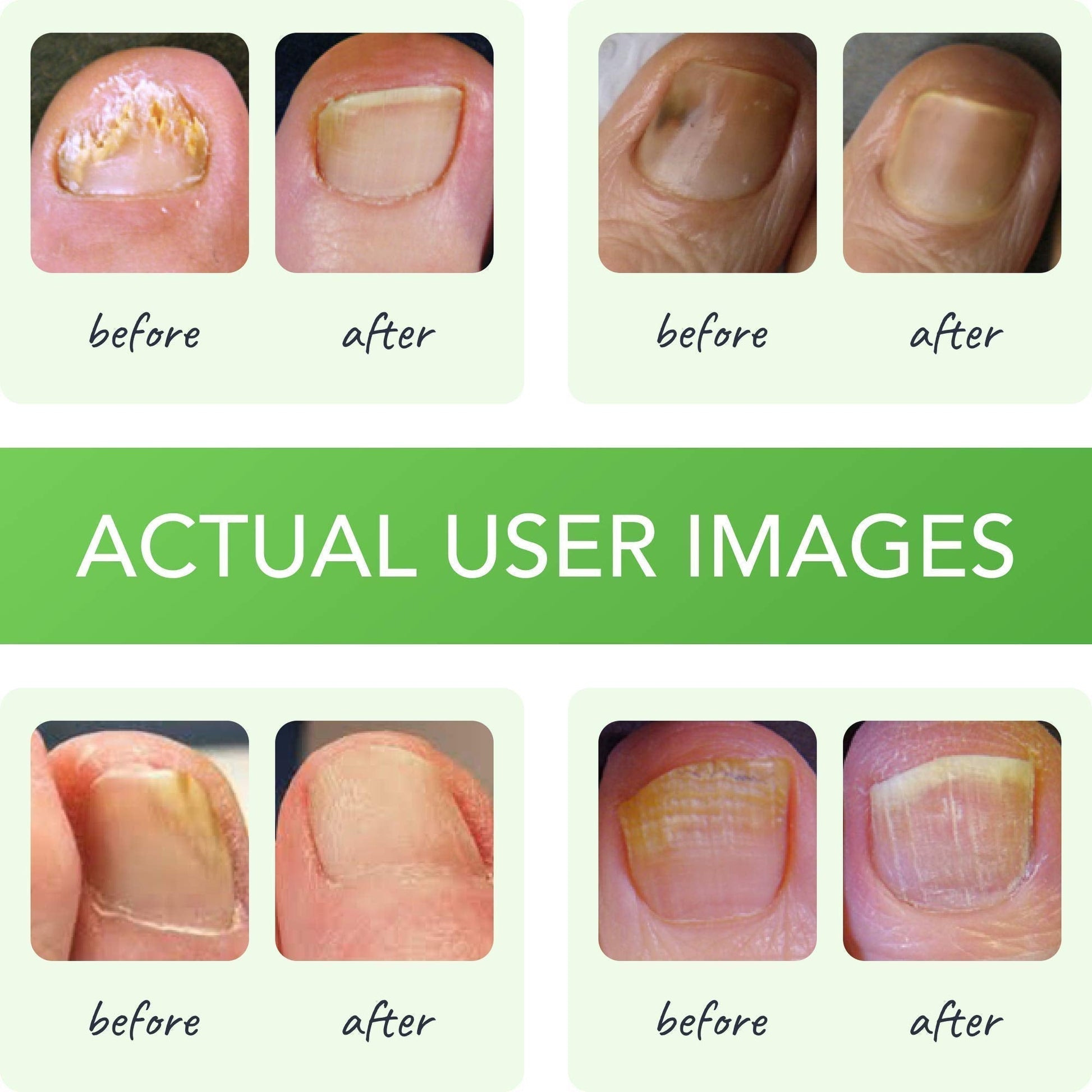 FUNGINIX Healthy Nail Formula - Finger And Toe Fungus Treatment, Made In USA, Foot FUNGINIXUS supplements