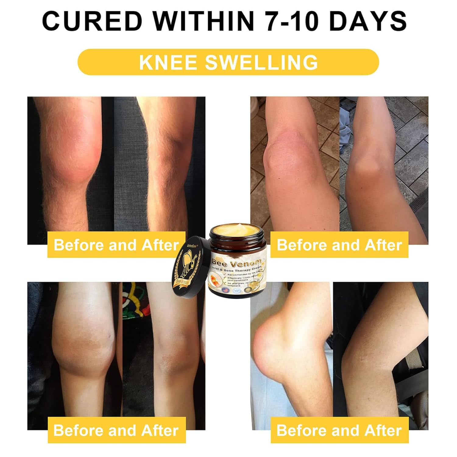 ArthroEase Bee Venom Arthritis Cream, Joint & Muscle Soothing Bee Venom Cream, Professional Bee Venom Joint Cream, Bee Venom Joint Gel - Specially for for Back, Neck, Hands, Knee (2 Bottle) LmoyAu supplements
