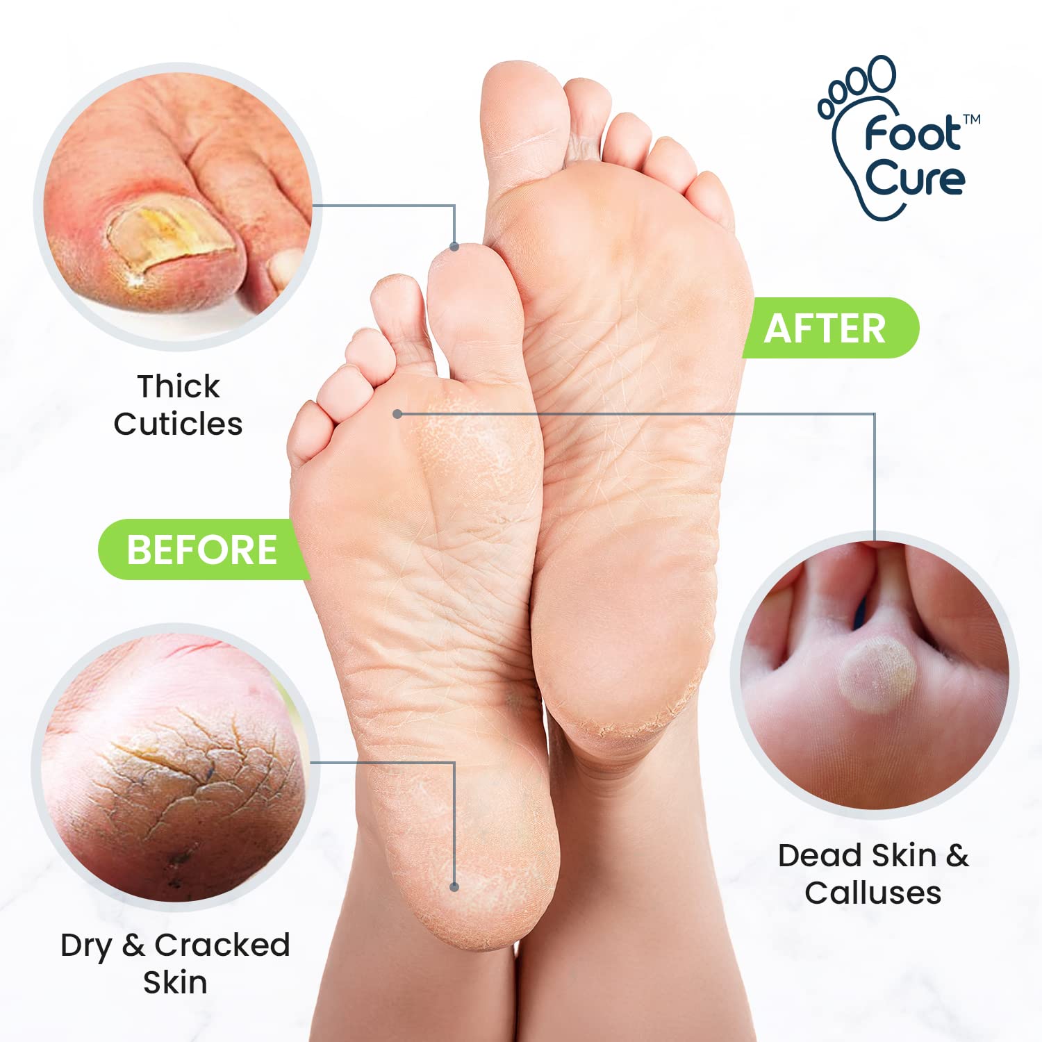 Toenail Fungus Treatment Extra Strength - Advance nail fungus treatment for fingernails FOOT CUREUS supplements