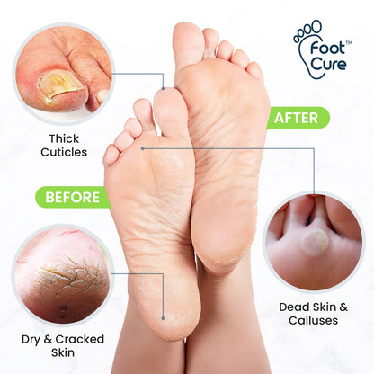 Toenail Fungus Treatment Extra Strength - Advance nail fungus treatment for fingernails FOOT CUREUS supplements