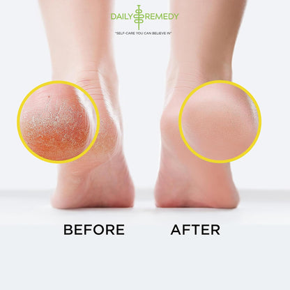 Citrus Detox Foot Soak with Epsom Salt - for Foot Callus, Immune Boost, Damaged Toenail DAILY REMEDYUS supplements