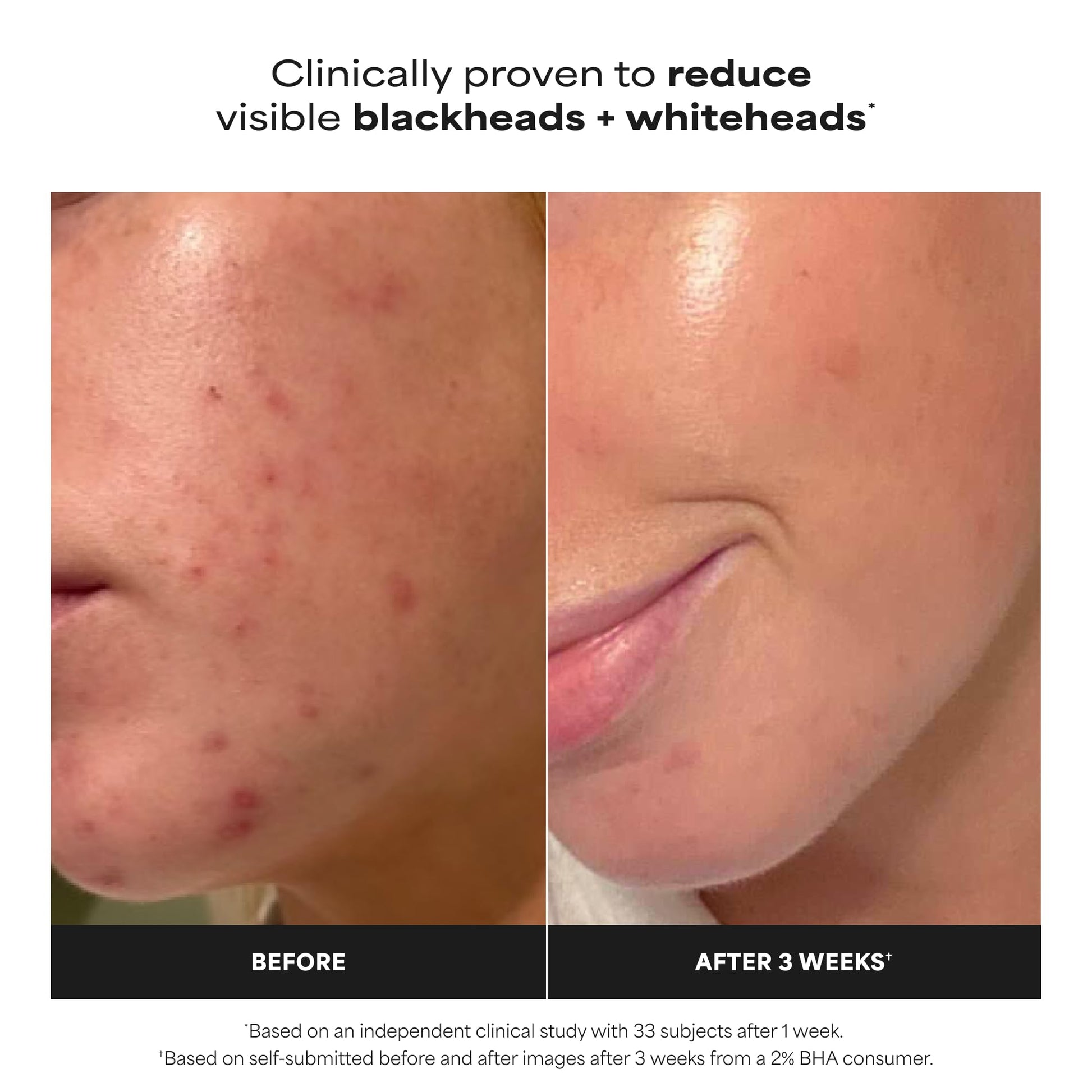 Paulas Choice--SKIN PERFECTING 2% BHA Liquid Salicylic Acid Exfoliant--Facial Exfoliant Paula's ChoiceUS supplements