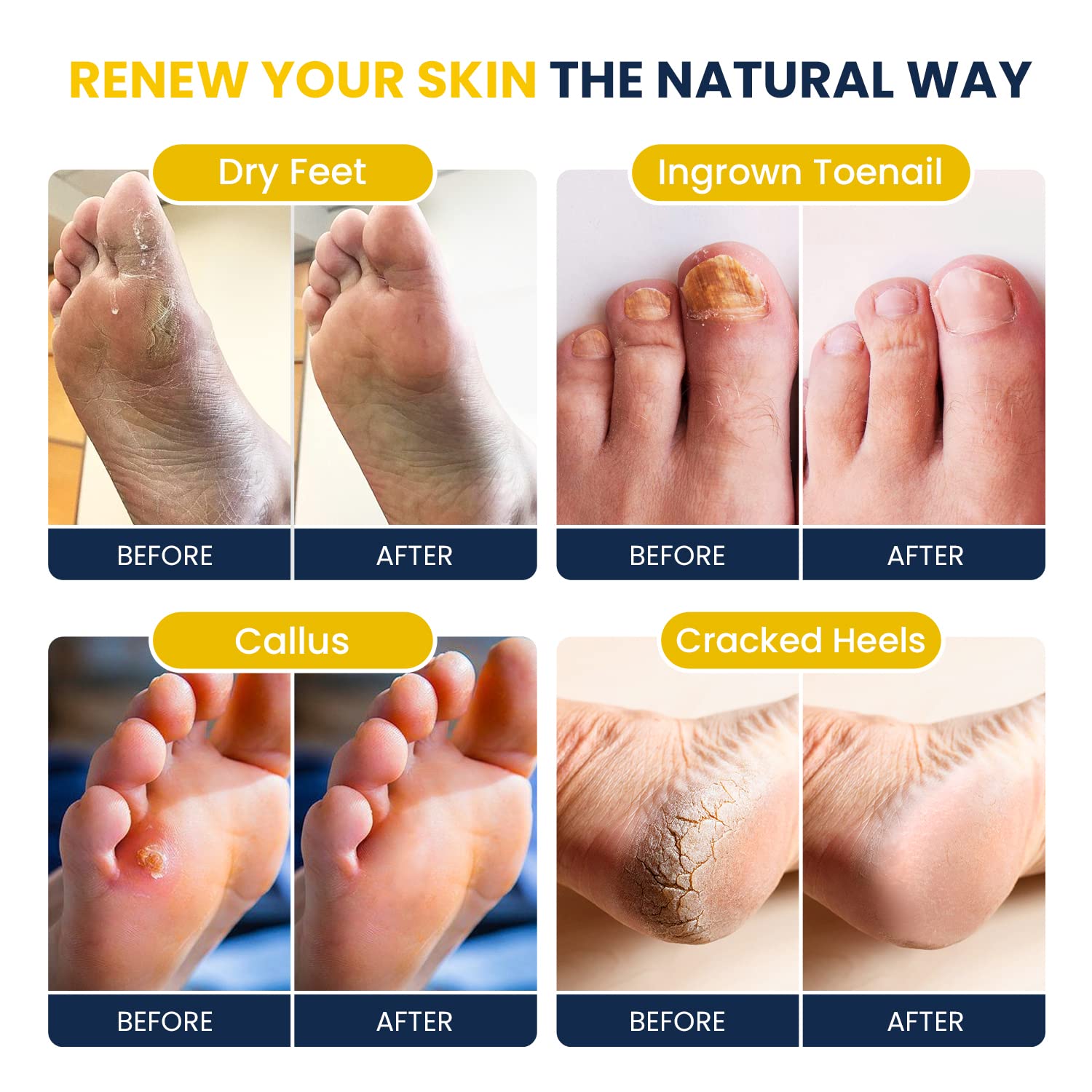 Citrus Detox Foot Soak With Epsom Salts - for Foot Callus, Immune Boost, Damaged Toenail FOOT CUREUS supplements