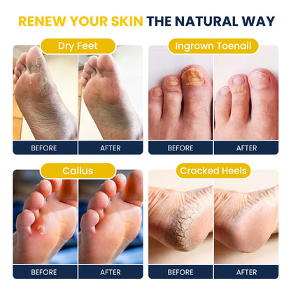 Citrus Detox Foot Soak With Epsom Salts - for Foot Callus, Immune Boost, Damaged Toenail FOOT CUREUS supplements