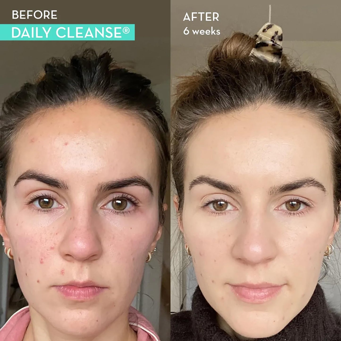 HUM Daily Cleanse Acne Supplements - Support for Clear Skin & Improved Digestion HUMUS supplements