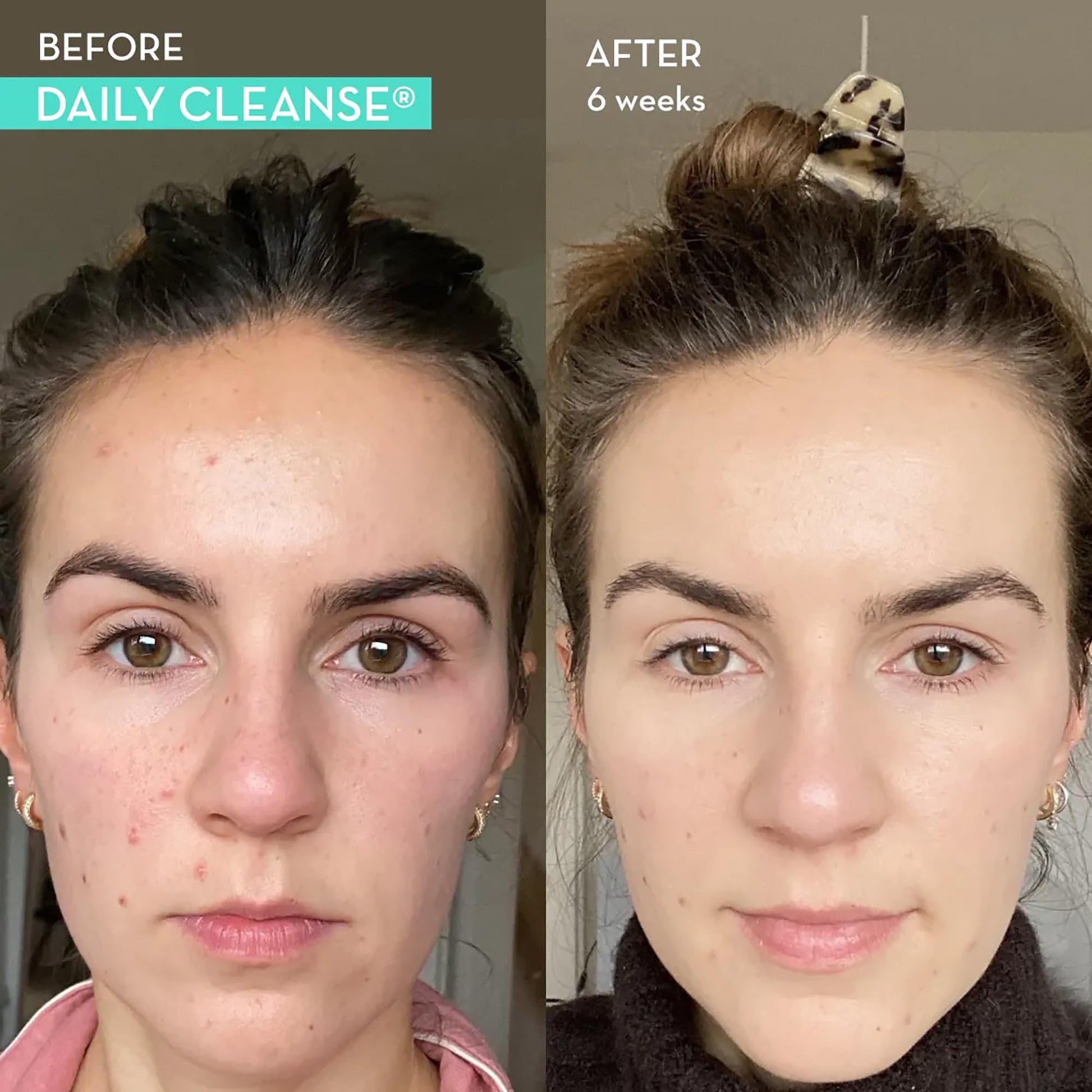 HUM Daily Cleanse Acne Supplements - Support for Clear Skin & Improved Digestion HUMUS supplements