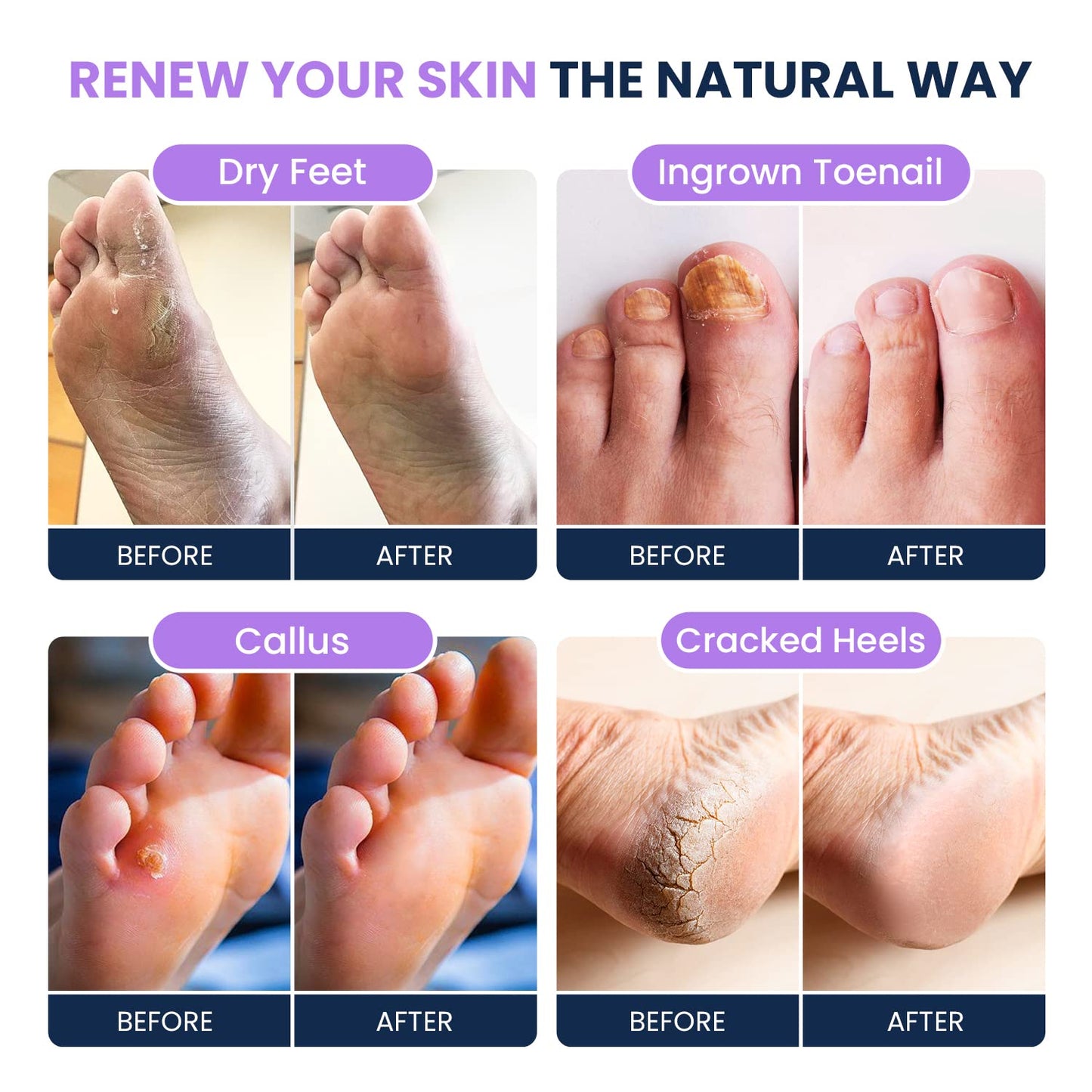 Soothing Lavender Foot Soak with Epsom Salt - Best Toenail Treatment, & Softens Calluses FOOT CUREUS supplements