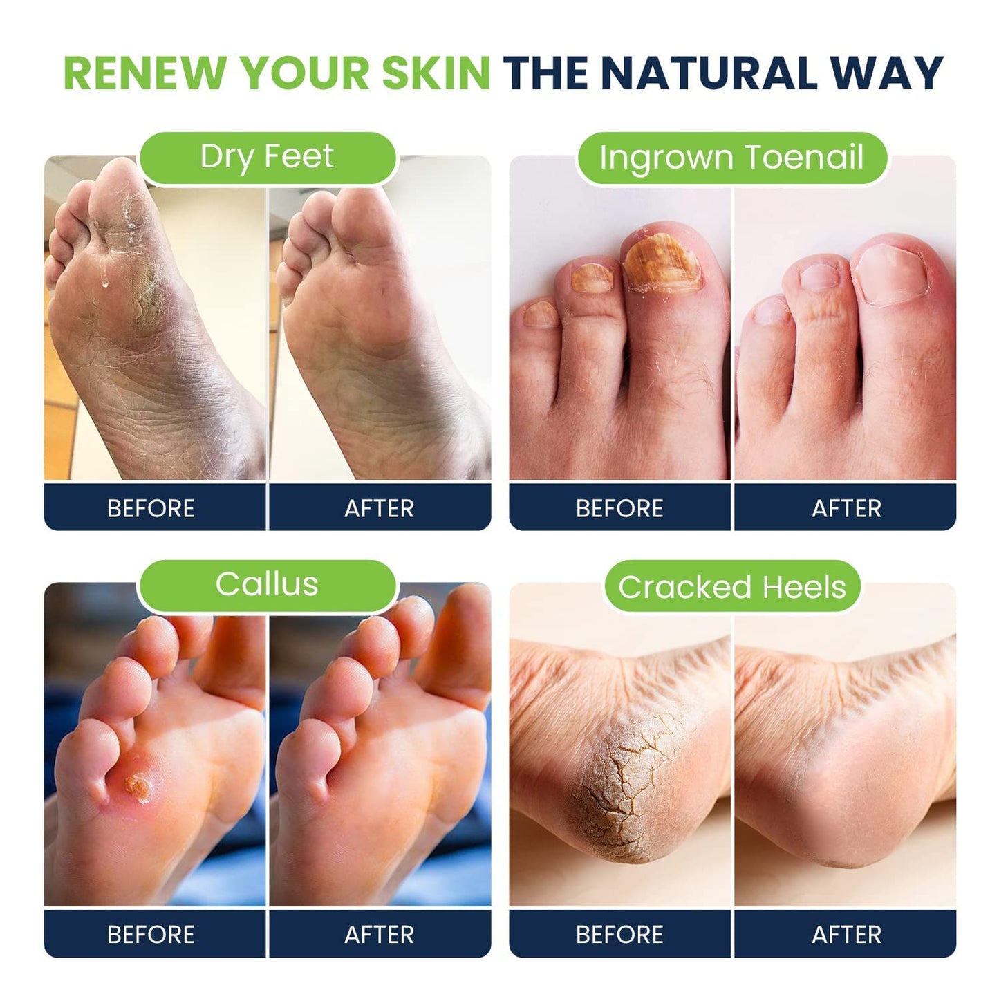 Tea Tree Oil Foot Soak with Epsom Salt - Best Toenail Fungus Treatment, Athletes FOOT CUREUS supplements