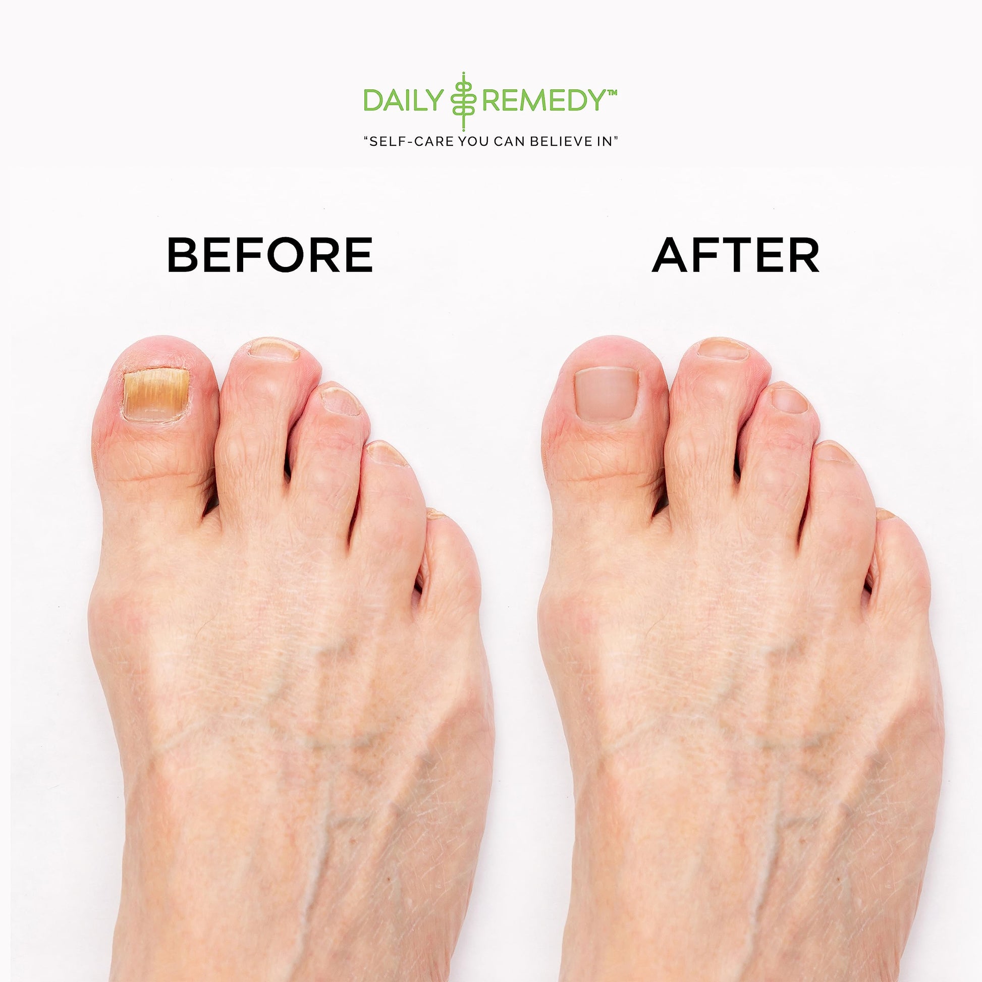 EXTRA STRENGTH Tea Tree Oil Foot Soak with Epsom Salt - Made in USA - for Toenails DAILY REMEDYUS supplements