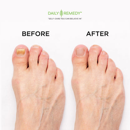 EXTRA STRENGTH Tea Tree Oil Foot Soak with Epsom Salt - Made in USA - for Toenails DAILY REMEDYUS supplements