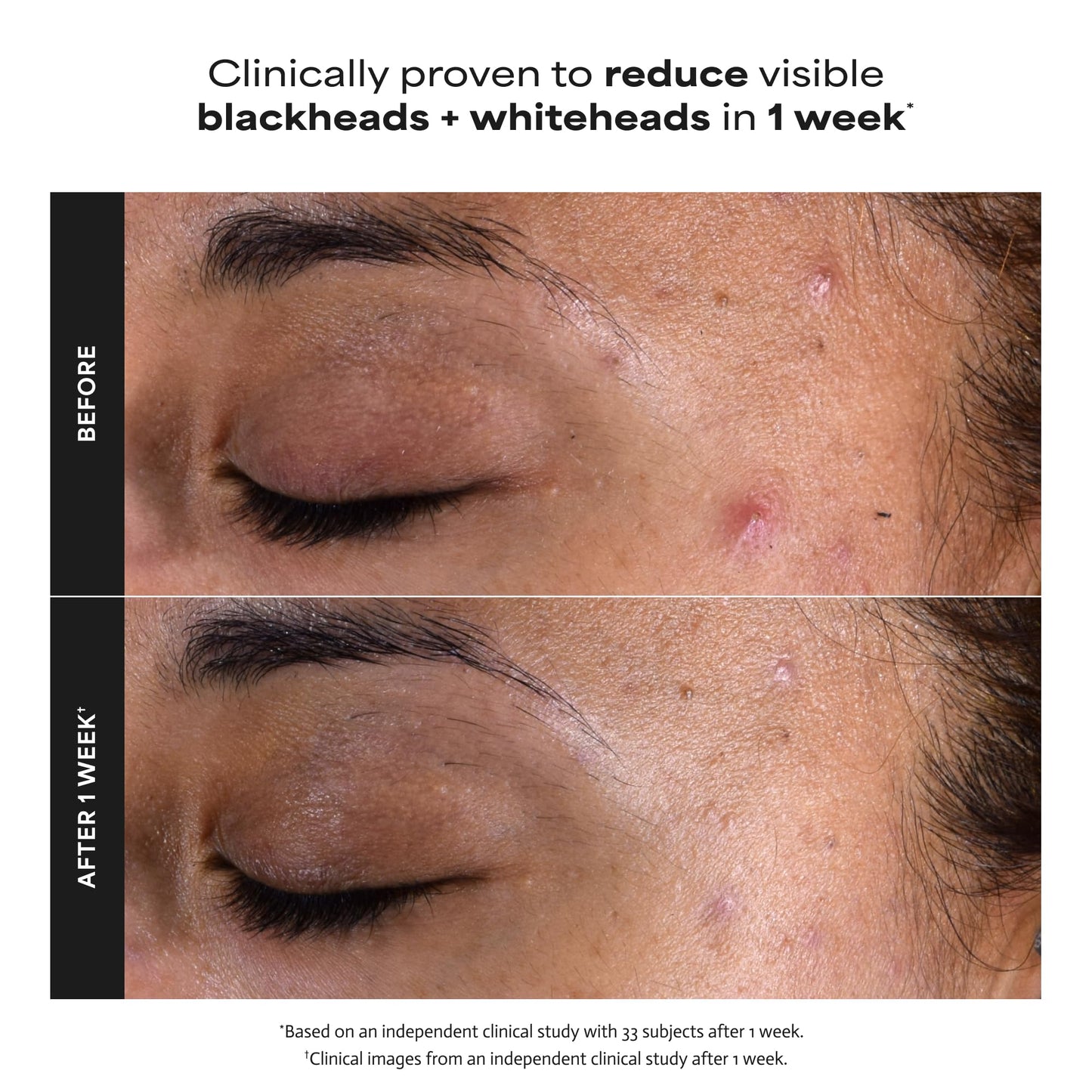 Paulas Choice--SKIN PERFECTING 2% BHA Liquid Salicylic Acid Exfoliant--Facial Exfoliant Paula's ChoiceUS supplements