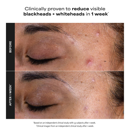 Paulas Choice--SKIN PERFECTING 2% BHA Liquid Salicylic Acid Exfoliant--Facial Exfoliant Paula's ChoiceUS supplements