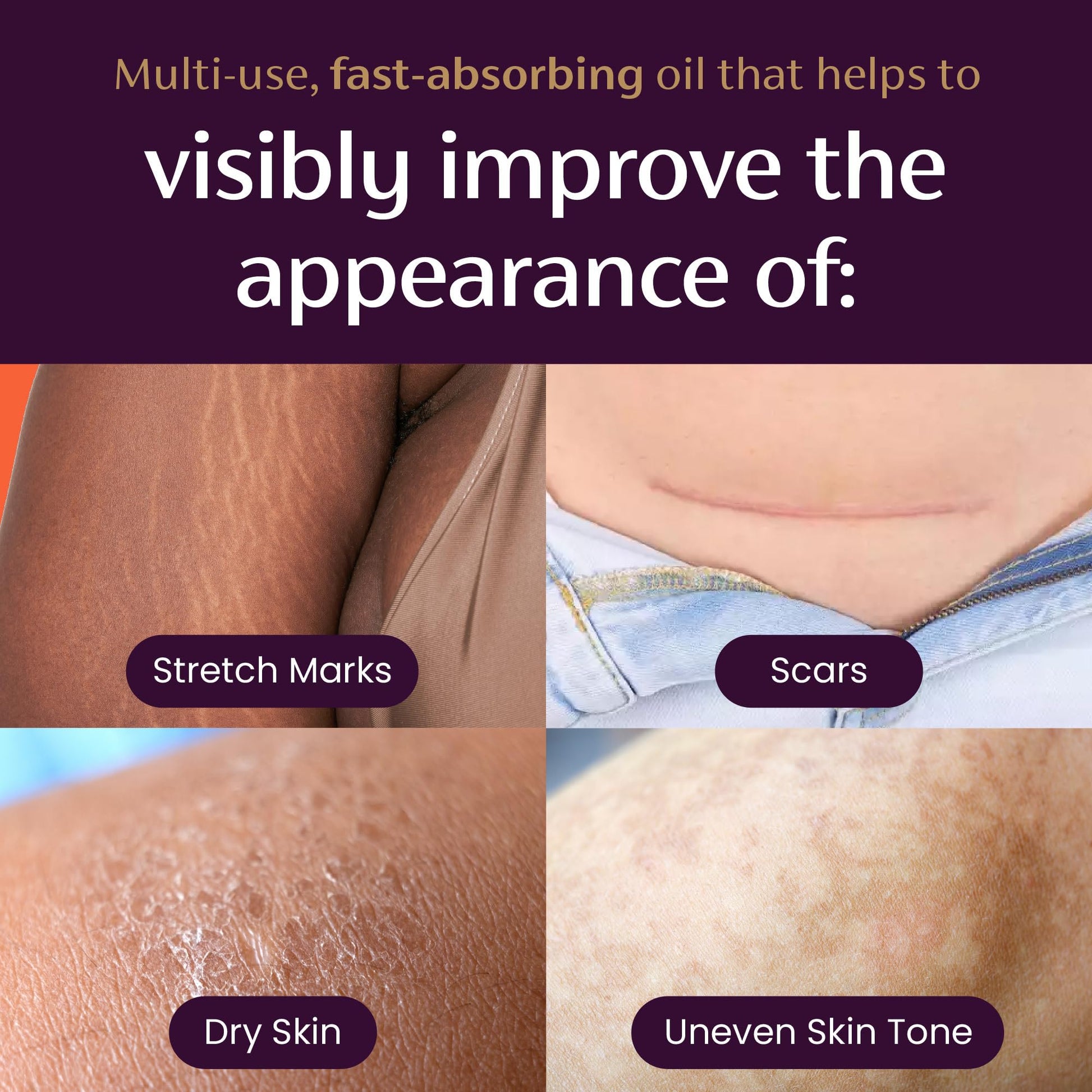 Mederma Quick Dry Oil, Scar and Stretch Mark Treatment, Helps to Improve the Appearance with Natural Botanical Extracts, Paraben Free, Fast-Absorbing, 3.4oz (100ml) MedermaAu supplements