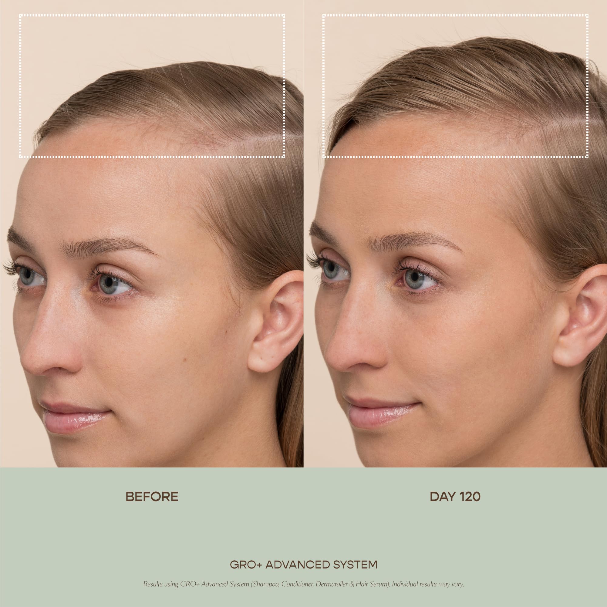 VEGAMOUR GRO+ Advanced Dermaroller | 1,200 Microneedle 0.25mm Scalp Tool | Gently Exfoliates the Scalp | Wide Head for Maximum Coverage VEGAMOURAu supplements