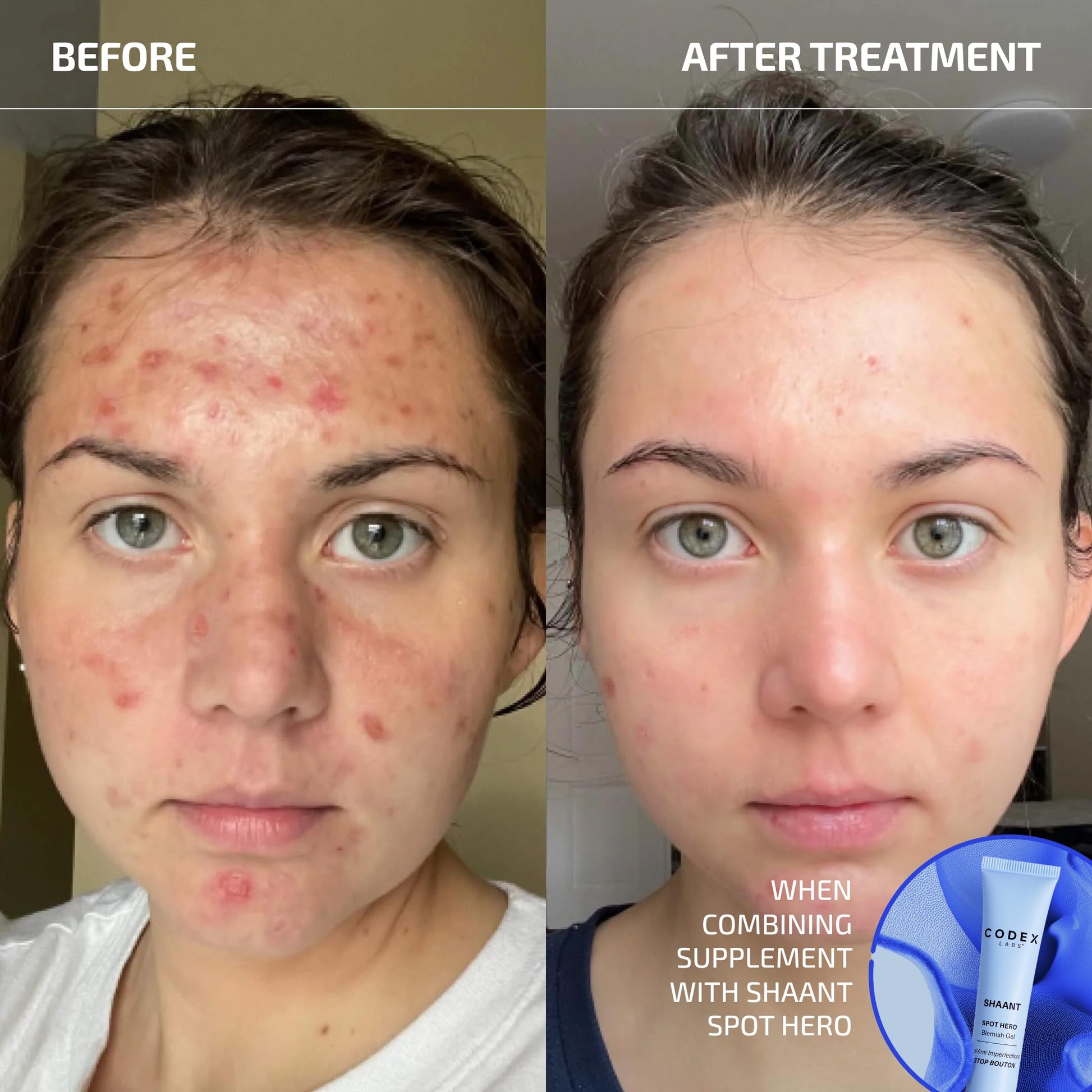 Codex Labs Shaant Clear Skin Supplement – 60 Vegan Capsules | Acne Probiotics with 9-Strain Blend, Green Tea EGCG & Guggul – Daily Support for Acne-Prone Skin & Clear Complexion Codex LabsAu supplements